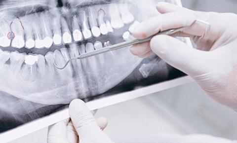 Pesquisadores da Unisa realizam estudo sobre o efeito do tabagismo em implantes dentários